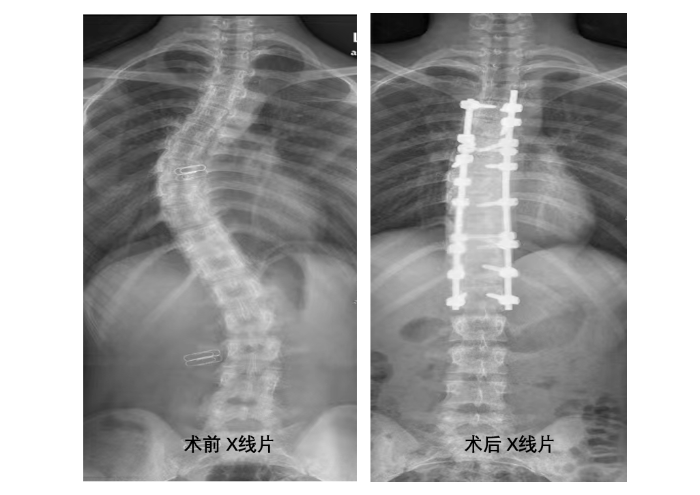 術(shù)前、術(shù)后x線片